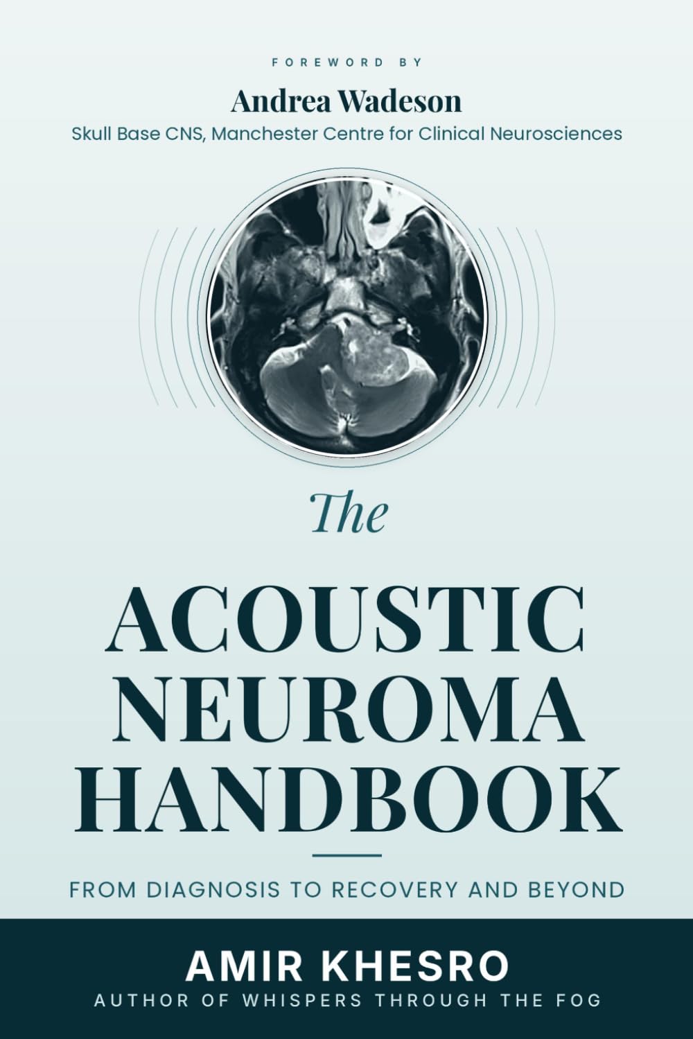 THE ACOUSTIC NEUROMA (VESTIBULAR SCHWANNOMA) HANDBOOK: From Diagnosis to Recovery and Beyond